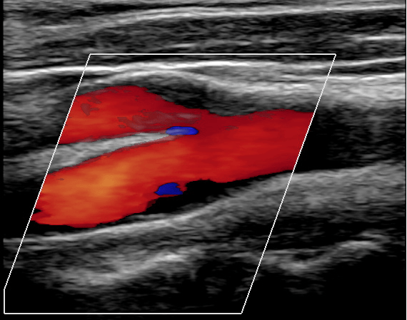 DopplerCarotidas
